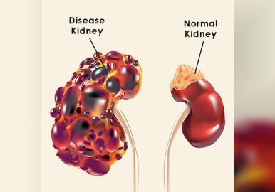 വേനൽക്കാലവും വൃക്കരോഗവും:ശ്രദ്ധിച്ചില്ലെങ്കിൽ പണി പാളും 